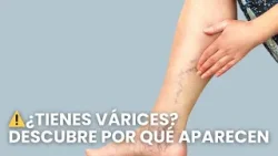 ¿Por qué aparecen las várices? La verdad que debes saber | Más conectados