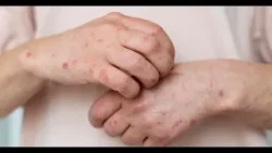 Alerta por sarampión: un caso podría infectar a 20 personas Alerta por sarampión: un caso podría infectar a 20 personas