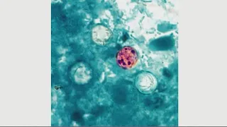 Cyclosporiasis Outbreak Spreads to Over 6,700 People Across the US, 2 Deaths Confirmed (August 4,...