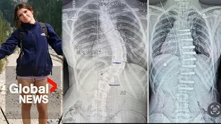 Alberta teen's family sues government after $200K US scoliosis surgery bill