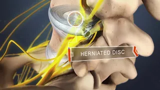 How to Recognize Sciatic Nerve Pain?