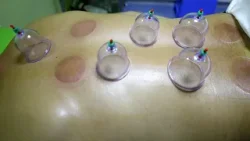 Na rubu znanosti: Hidžama - drevna metoda detoksikacije krvi