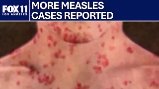 Measles cases surging in California