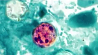 'Explosive diarrhea' parasitic infection continues to spread in US