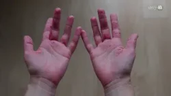 Sólo en la primera quincena de 2026, Jalisco registra 256 contagios de sarampión