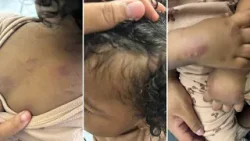 Detroit mom says 1-year-old bitten and bruised at child care center