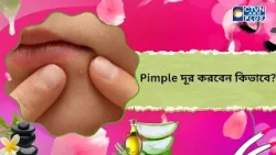 Pimple দূর করবেন কিভাবে। Beauty