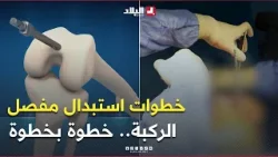 #شاهدوا الخطوات الدقيقة لاستبدال مفصل على الركبة.. وهكذا تُجرى العملية خطوة بخطوة ?