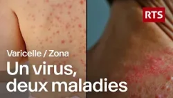 Zona : quand le virus de la varicelle se réveille | RTS Zona : quand le virus de la varicelle se réveille | RTS